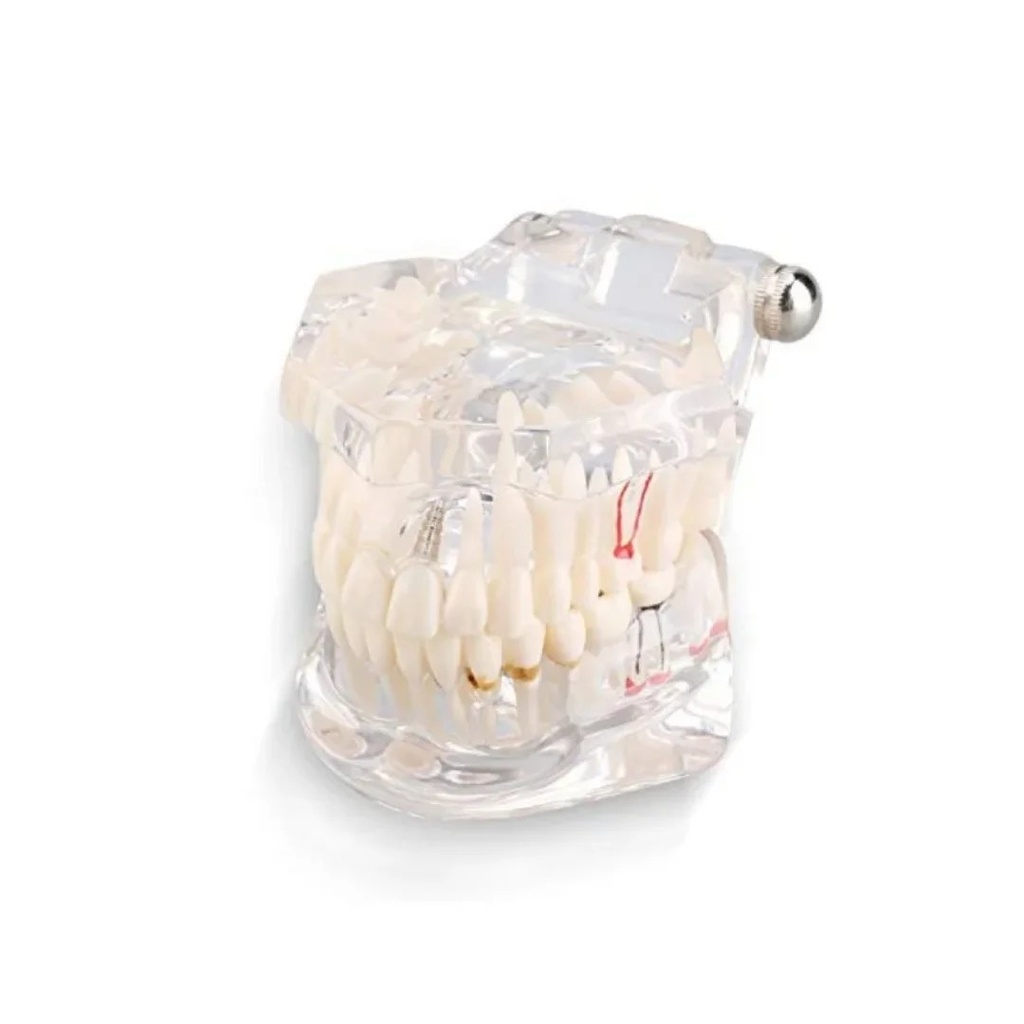 Modelo De Implante Y Endodoncia