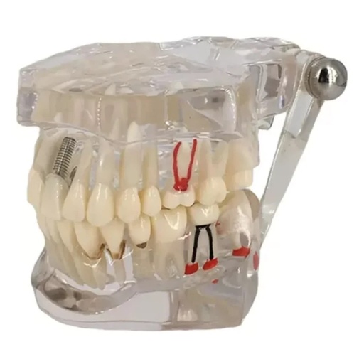 Modelo De Endodoncia