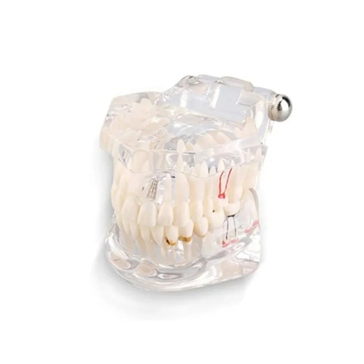 Modelo De Implante Y Endodoncia